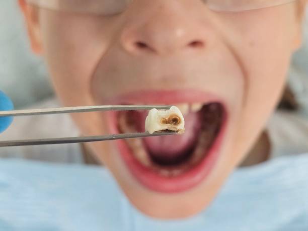 Best Emergency Treatment for Toothache in Clermont, FL